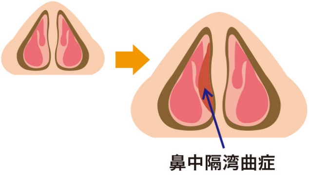 鼻中隔湾曲症