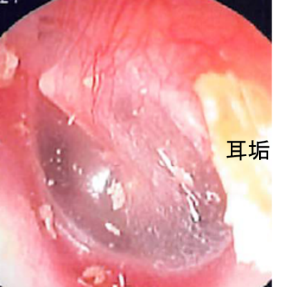 正常な鼓膜