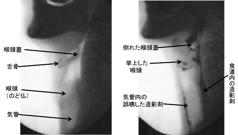 嚥下造影検査