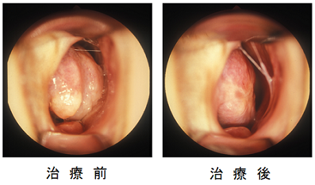 レーザー治療前後の鼻腔内所見