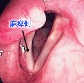 反回神経麻痺