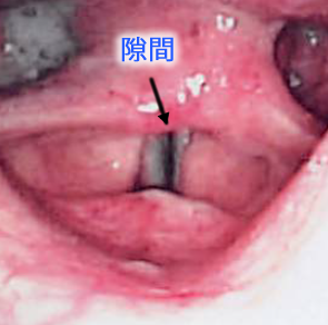 反回神経麻痺